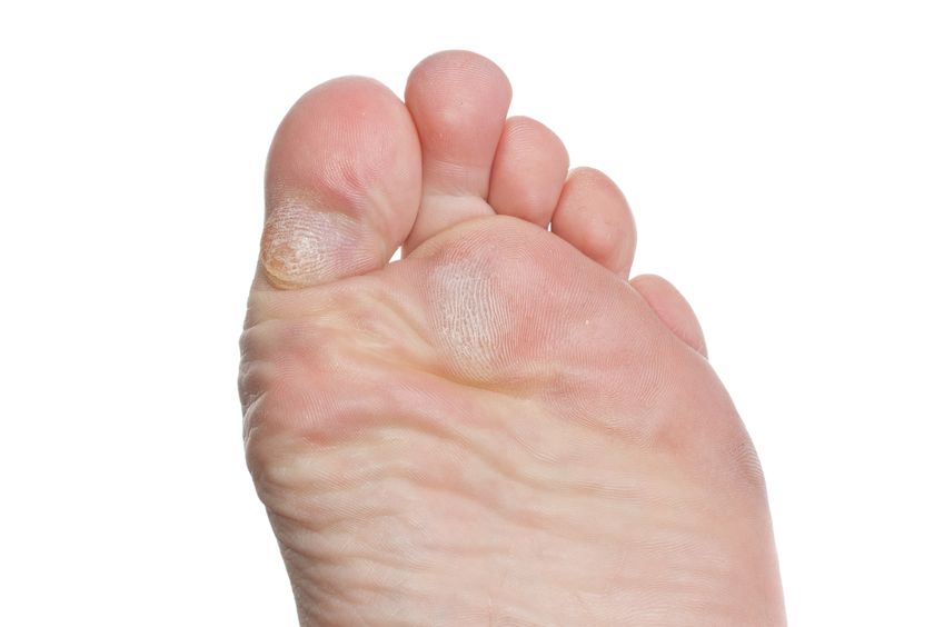 Corns-Rolle-Podiatry-and-Foot-Health-Budleigh