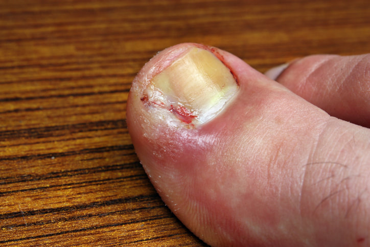 Ingrowing-toenail-Chiropodist-Budleigh-East-Devon